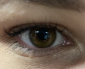 Auge Glaukom